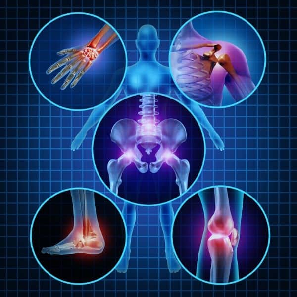 arthritis pain joints