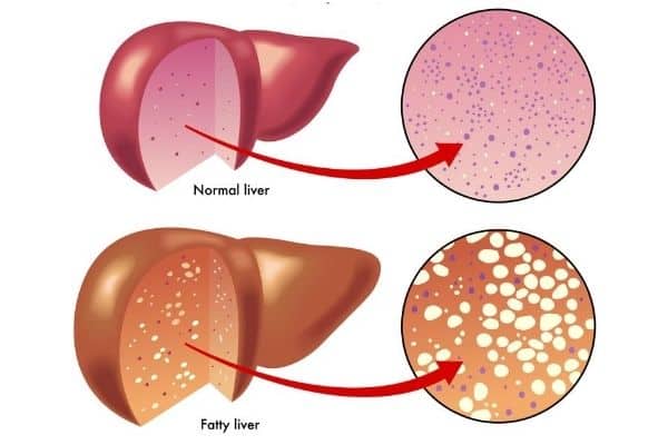 normal and fatty liver
